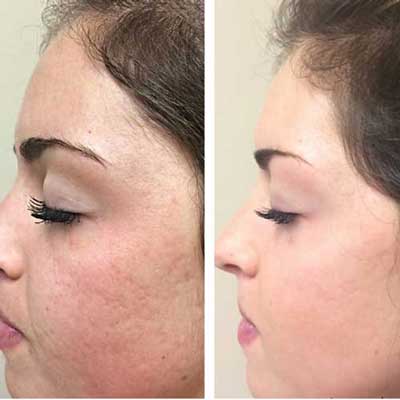 عکس قبل و بعد از پاکسازی پوست